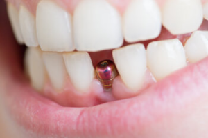 cheap dental implants sydney