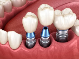 dental implant procedure sydney