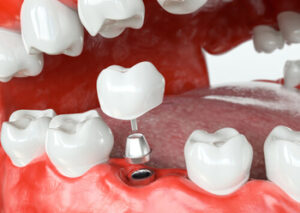 bali dental implant cost