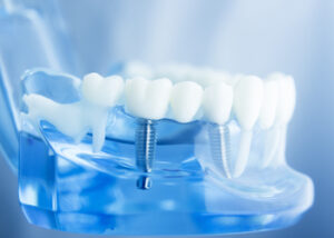all 4 teeth implant sydney