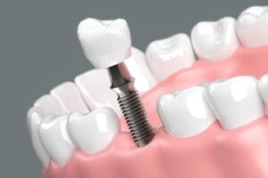 whole 4 implant dentist sydney