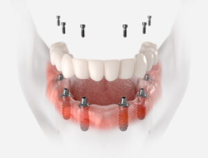 dental implant compared with bridge sydney