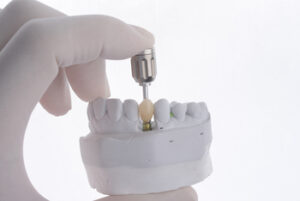 dental implant value sydney