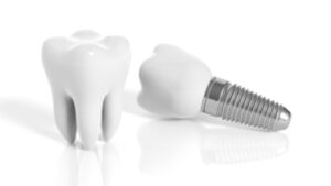 low price tooth implants sydney