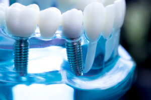 price of local teeth implant sydney