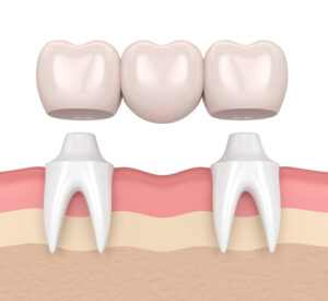 tooth implants againsts bridge sydney
