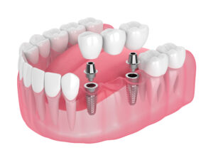 tooth implants contrasted with bridge sydney