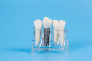 value foreign dental implants sydney